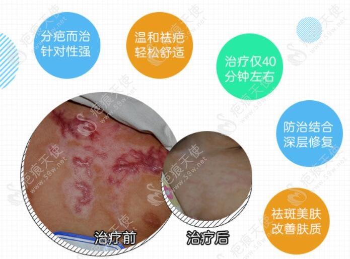 北京国丹治疗疤痕的优势